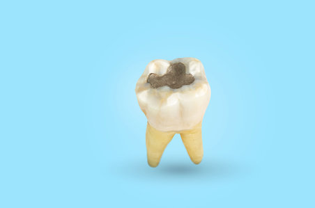 Tout savoir sur les différents plombages dentaires et leur prix