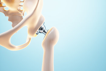 Remboursement prothèse de hanche : opération et soins