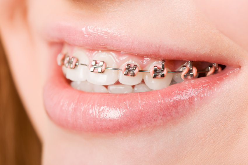 Les dentistes et la dérive des soins d'orthodontie - ADP Assurances